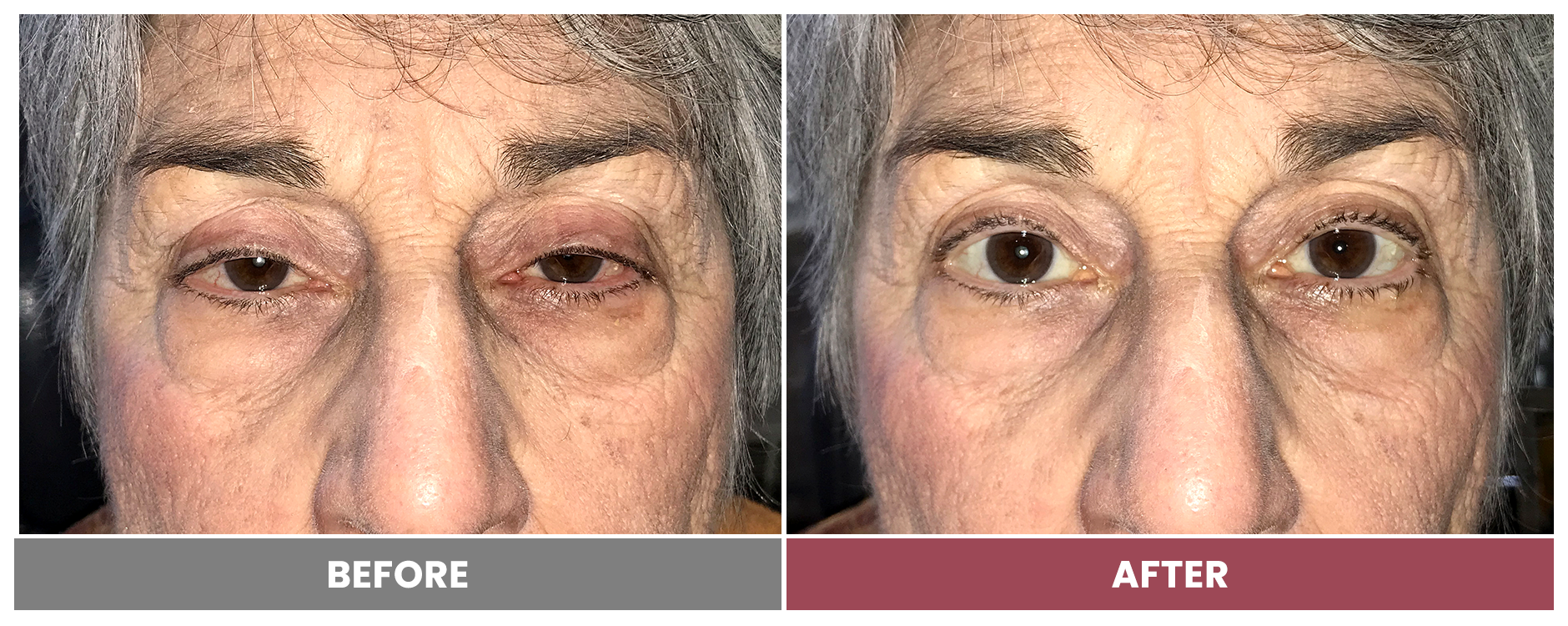 PTOSIS REPAIR - Case 32